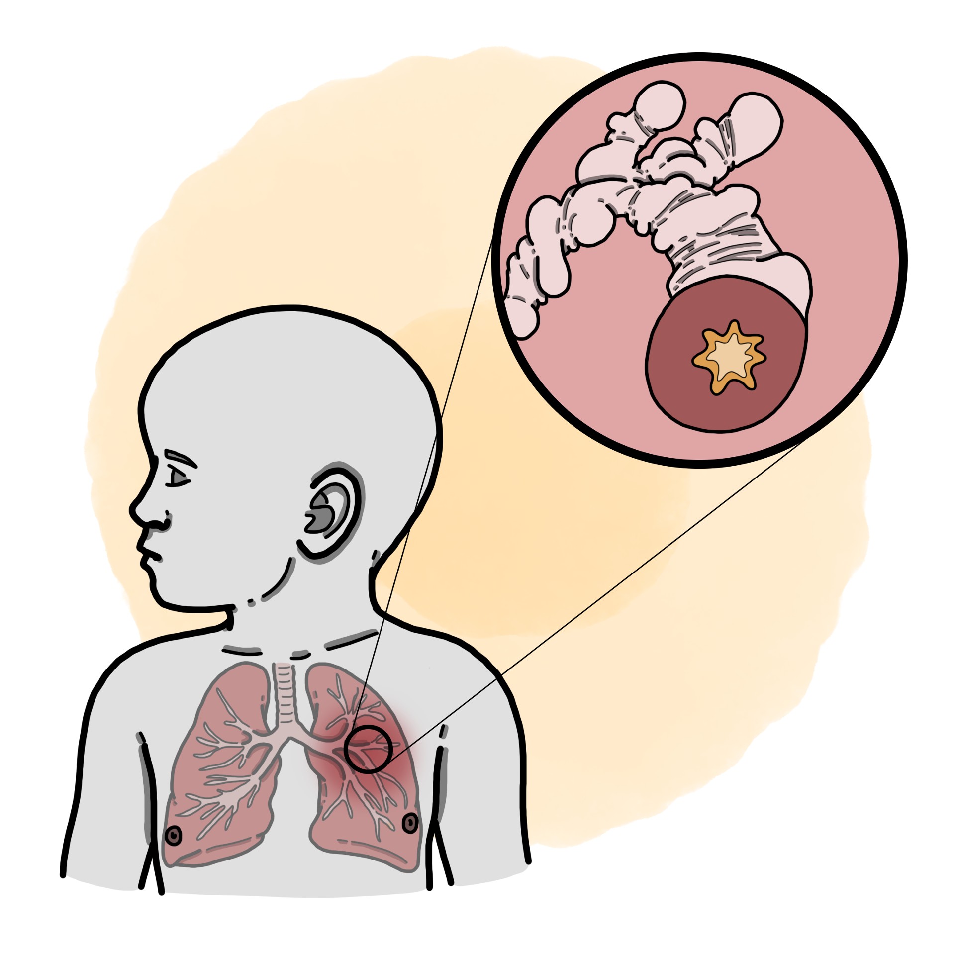 Bronchiolitis (Paediatrics)