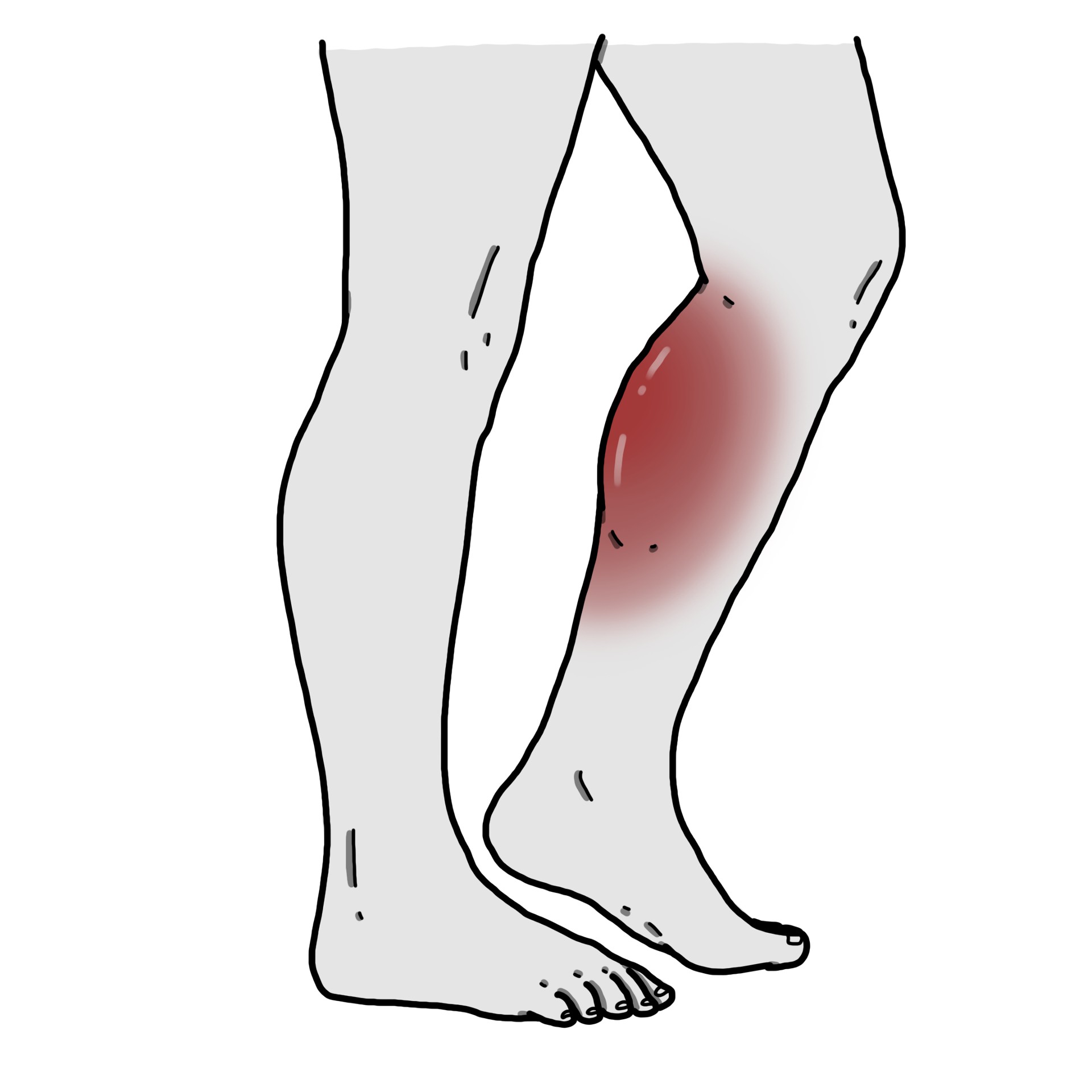 Mollet dur, chaud et douloureux