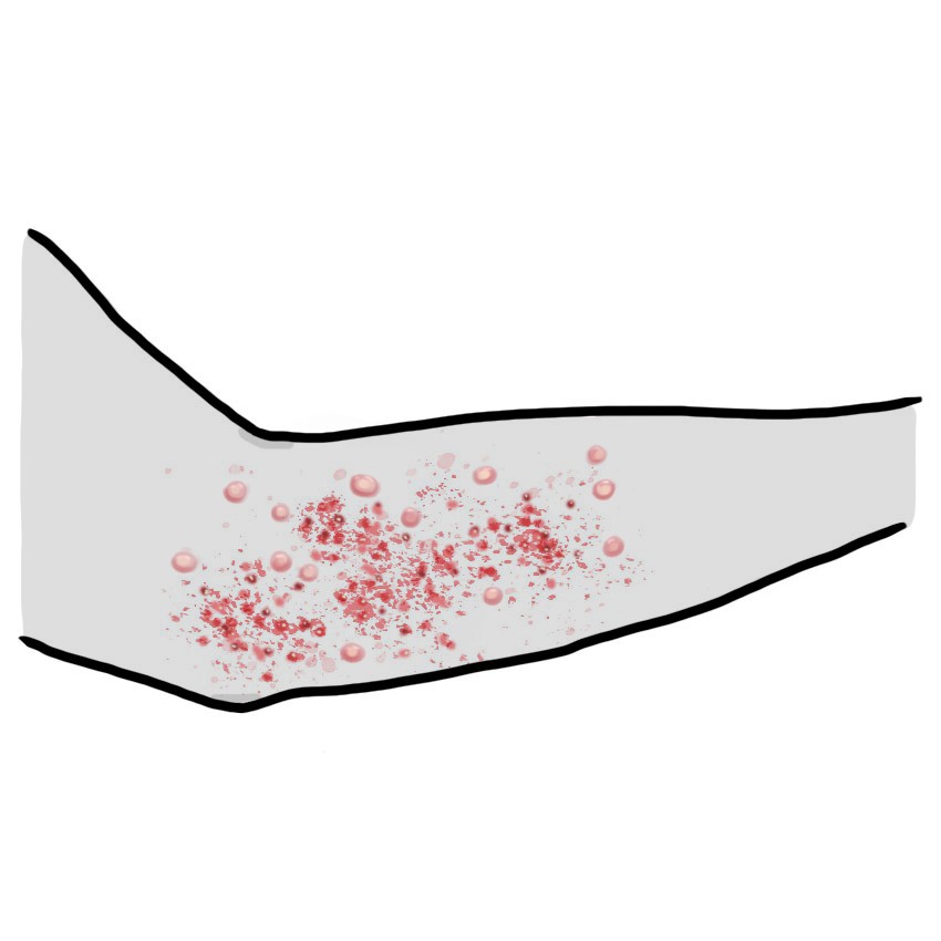 Vescicole e/o pustole sulla pelle