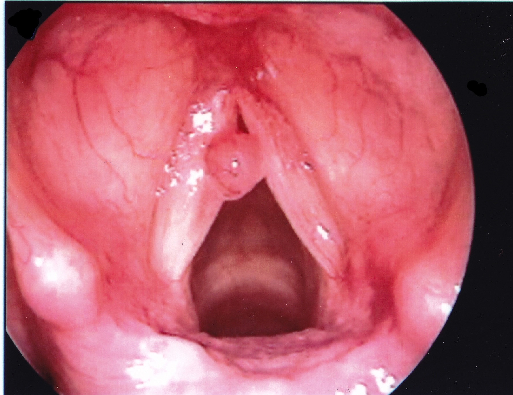 Laryngeal polyps / nodules