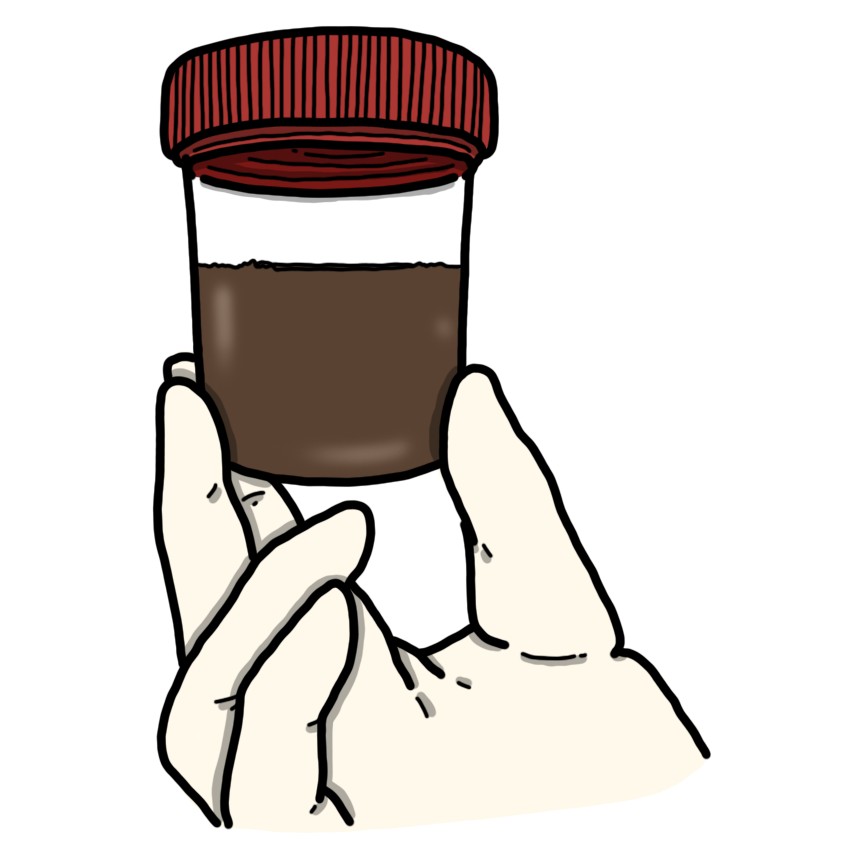 Orina fosca de color "Coca-Cola"