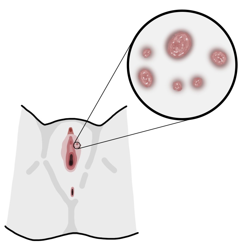 Condyloma acuminatum or anogenital wart