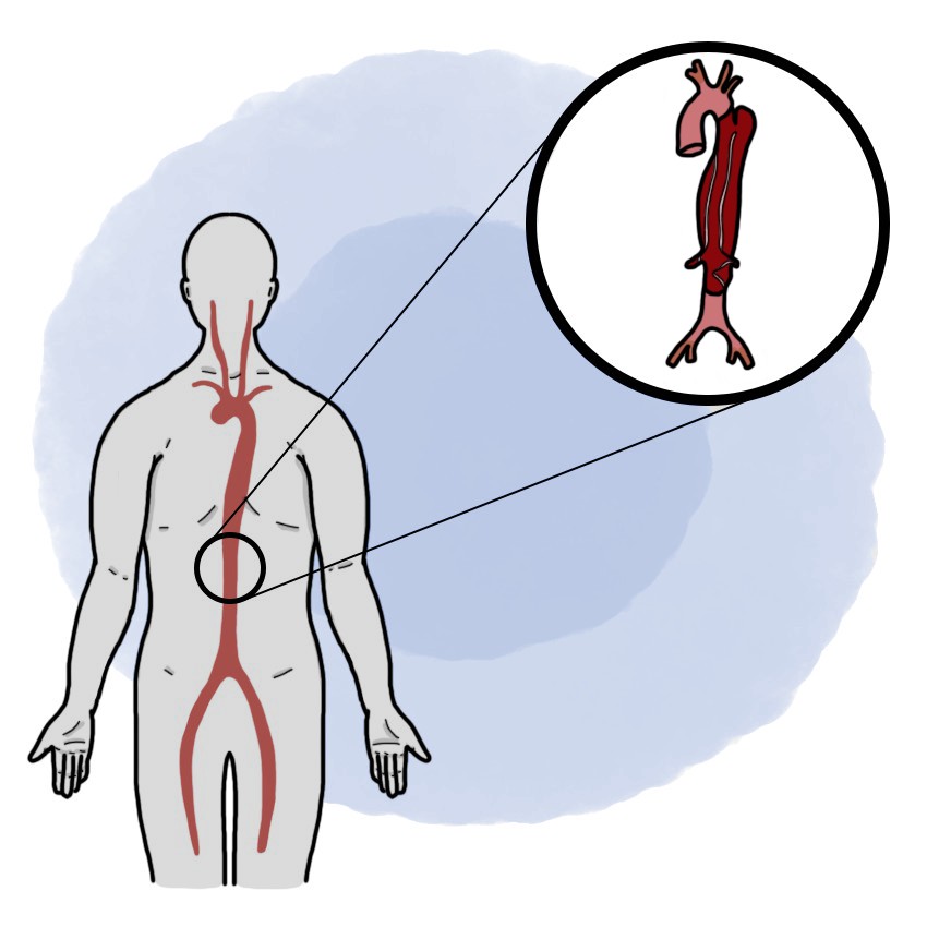 Type-B aortic dissection - Distal