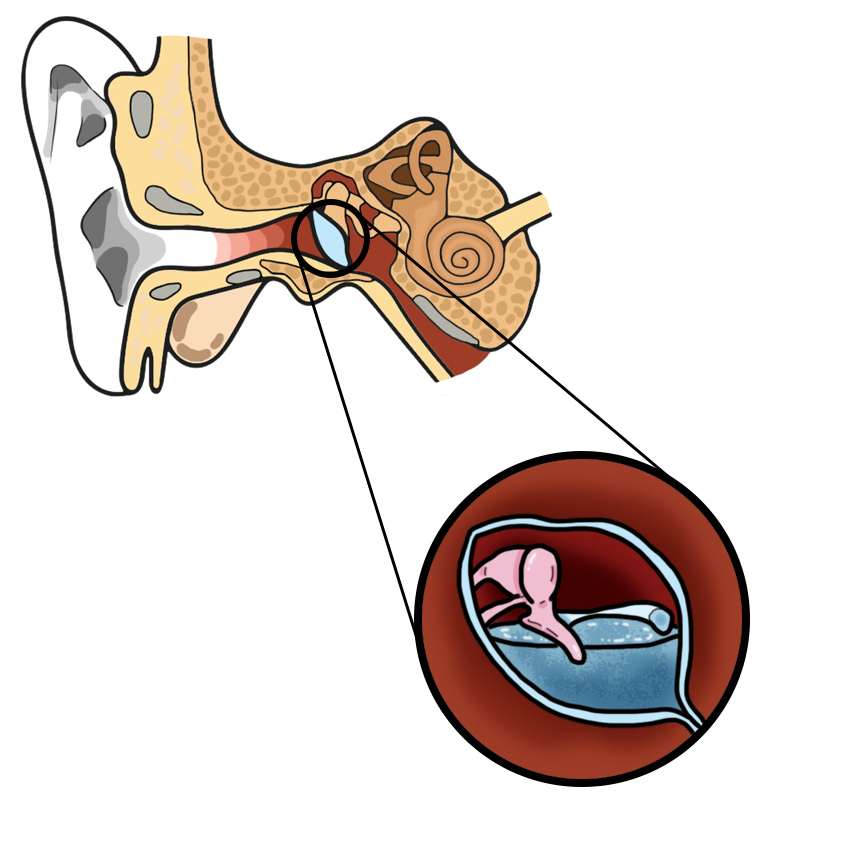 Sensación de líquido dentro del oído
