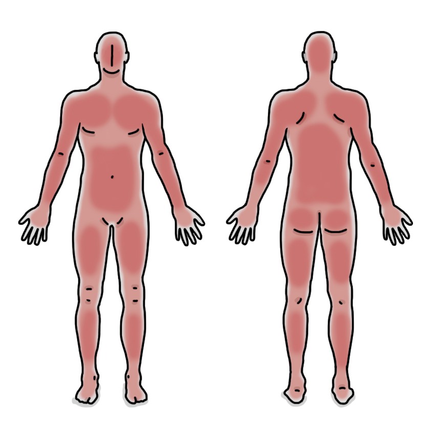 全身の皮膚の発赤