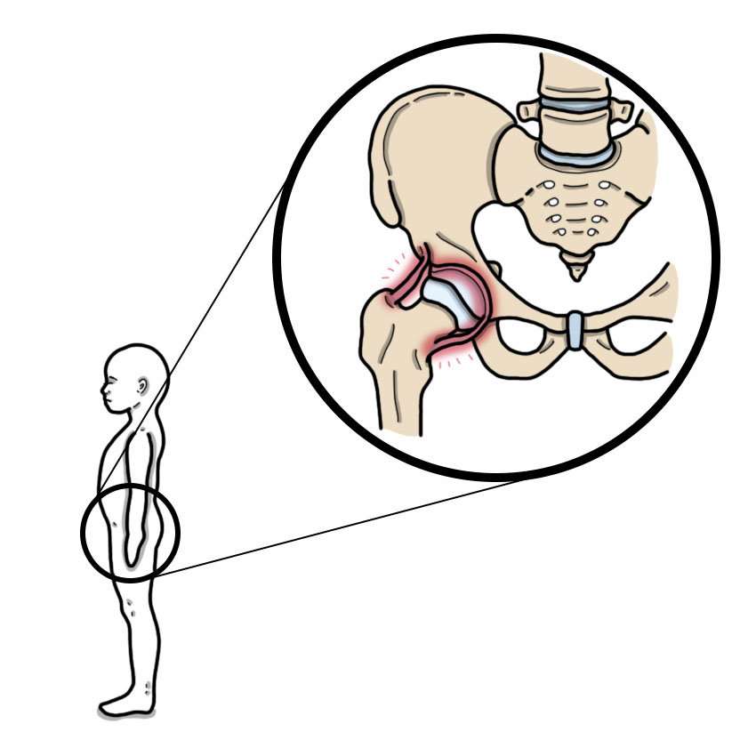 Paediatric transient synovitis of the hip (Paediatrics)