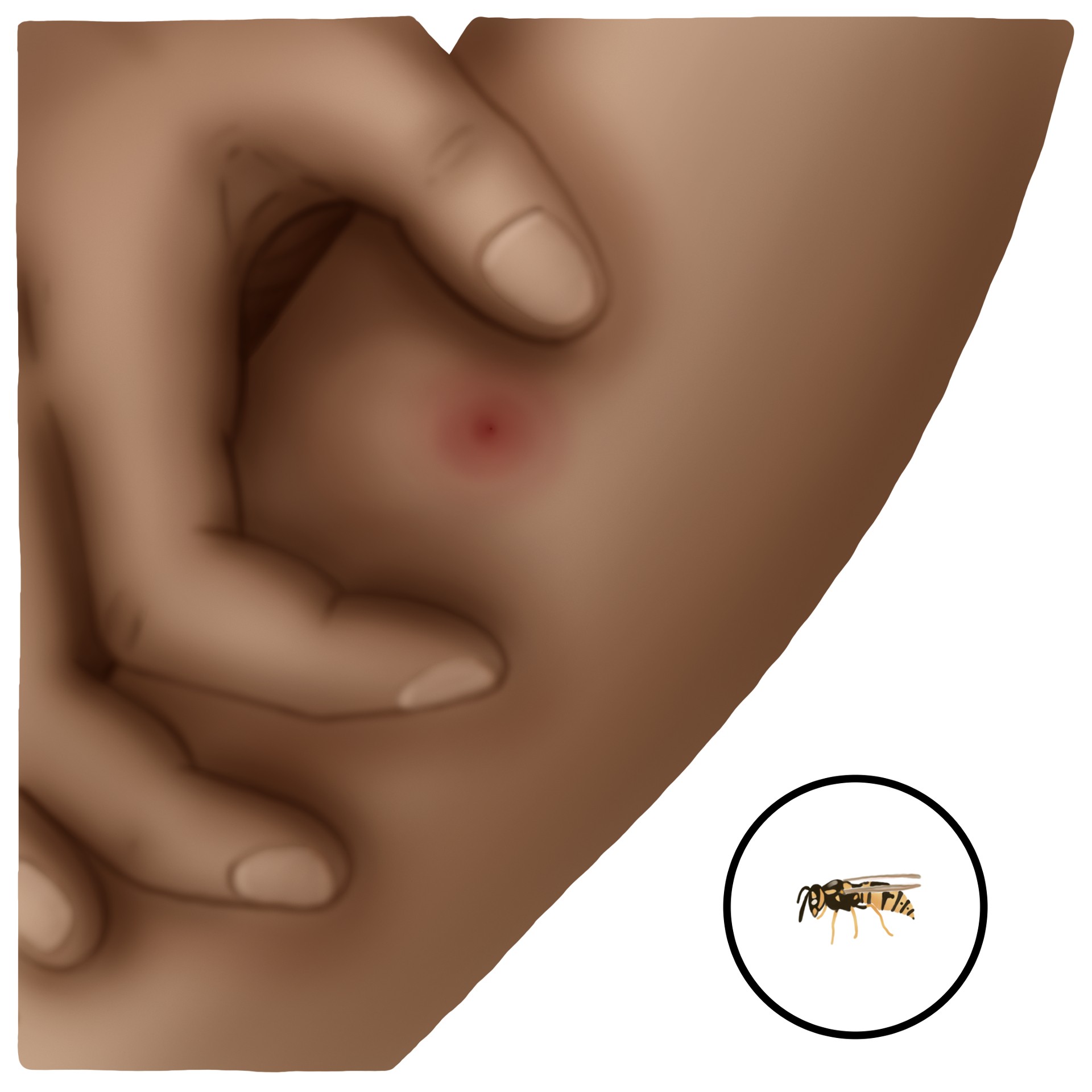 Bee/wasp sting
