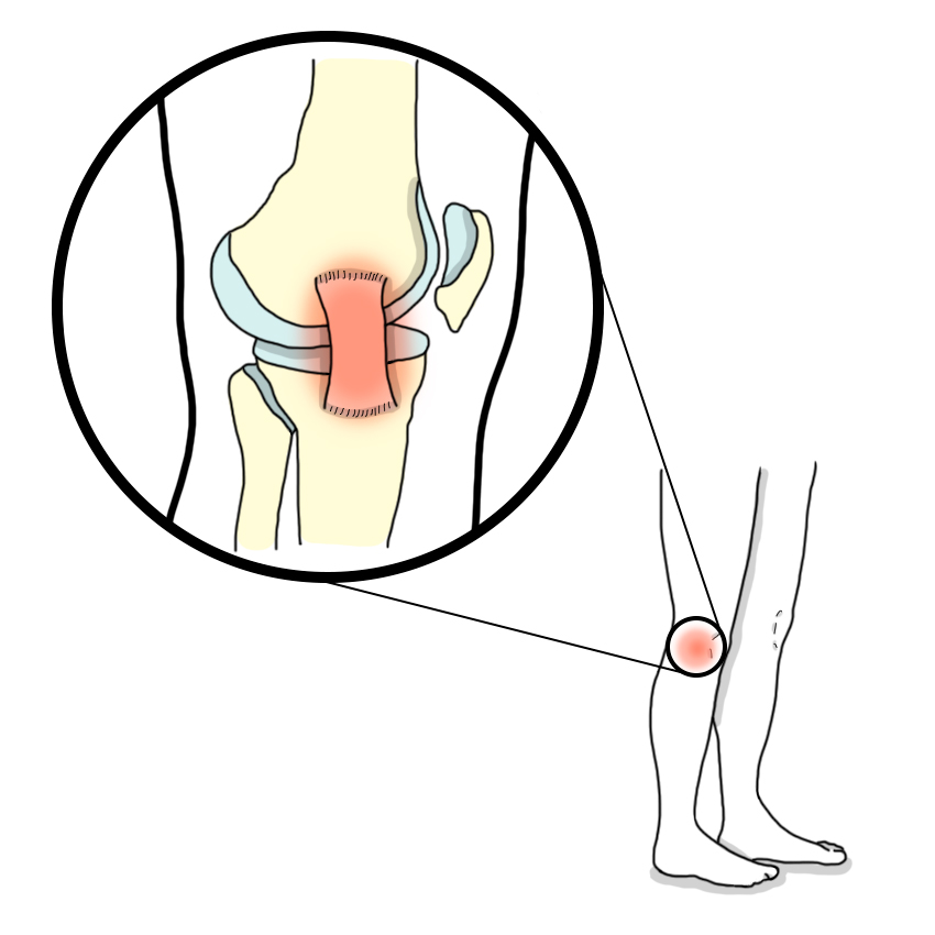 Lateral collateral ligament injury in the knee