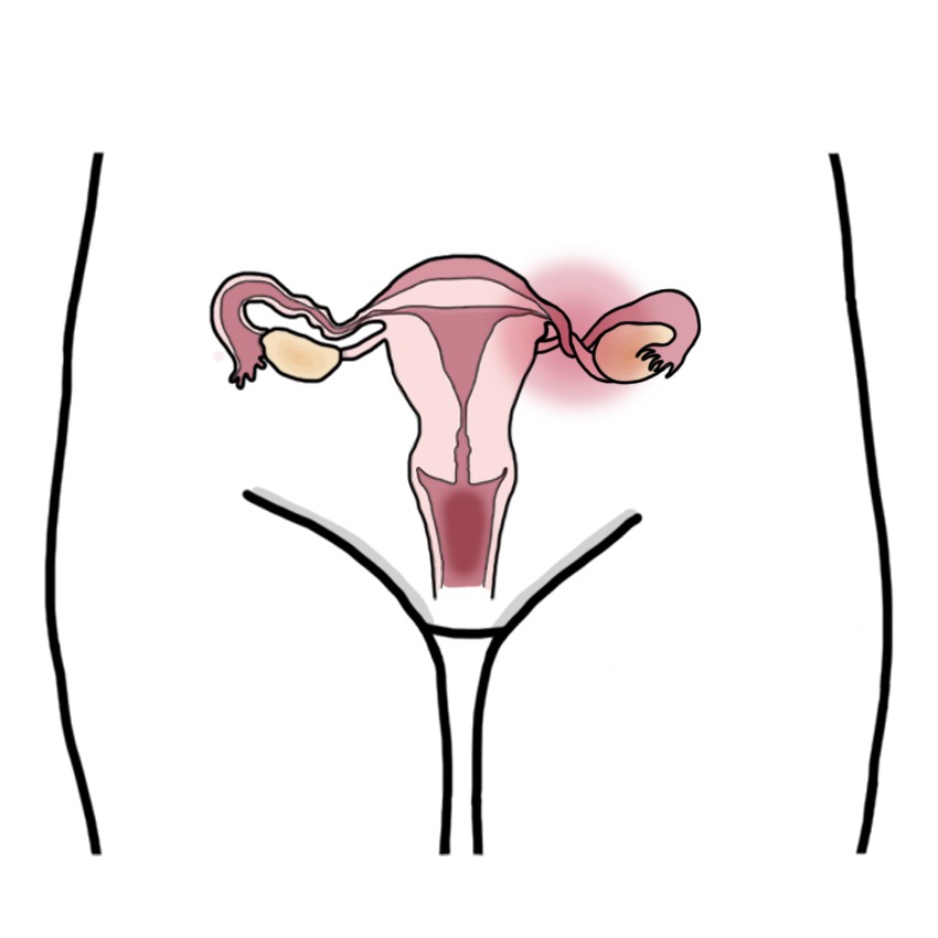 Ovarian torsion - Adnexal torsion