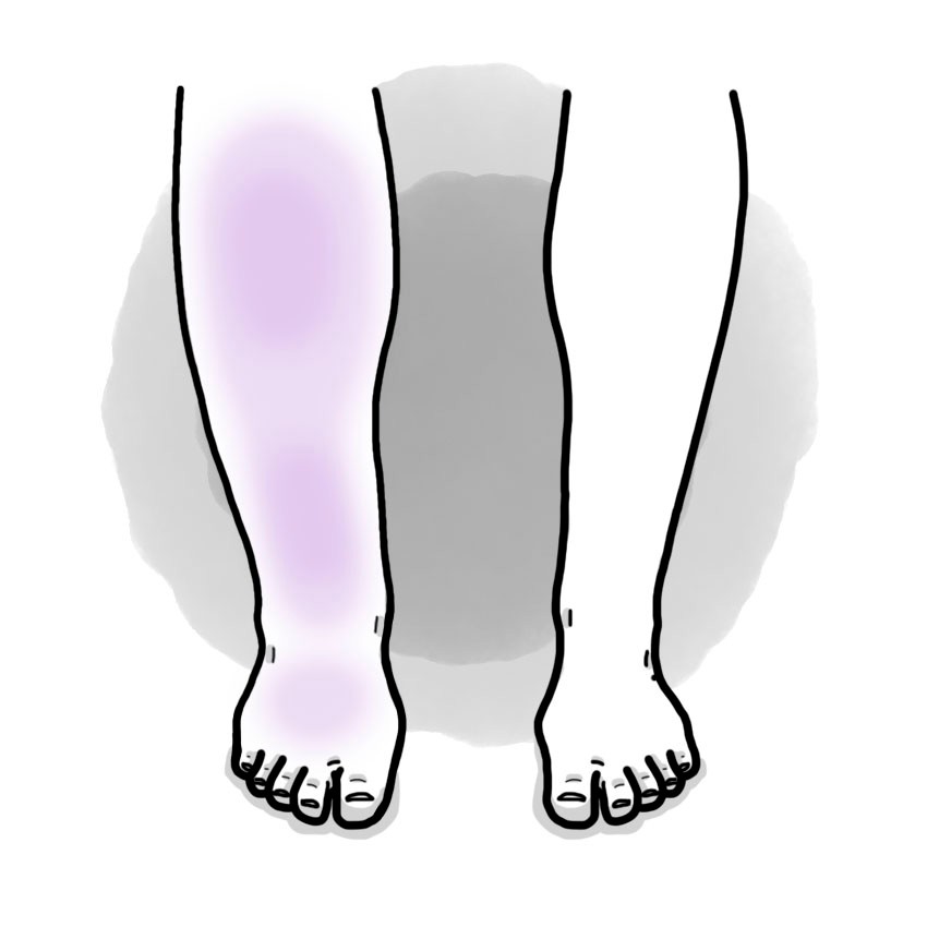 Isquemia arterial aguda por embolia