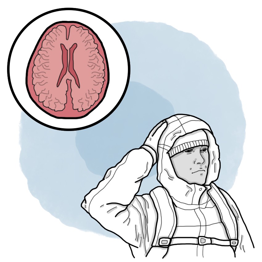 High-altitude cerebral oedema - HACO