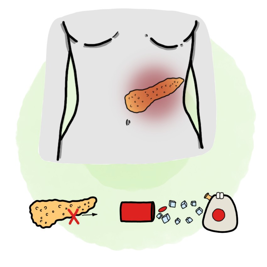 Diabetes mellitus tipo 2