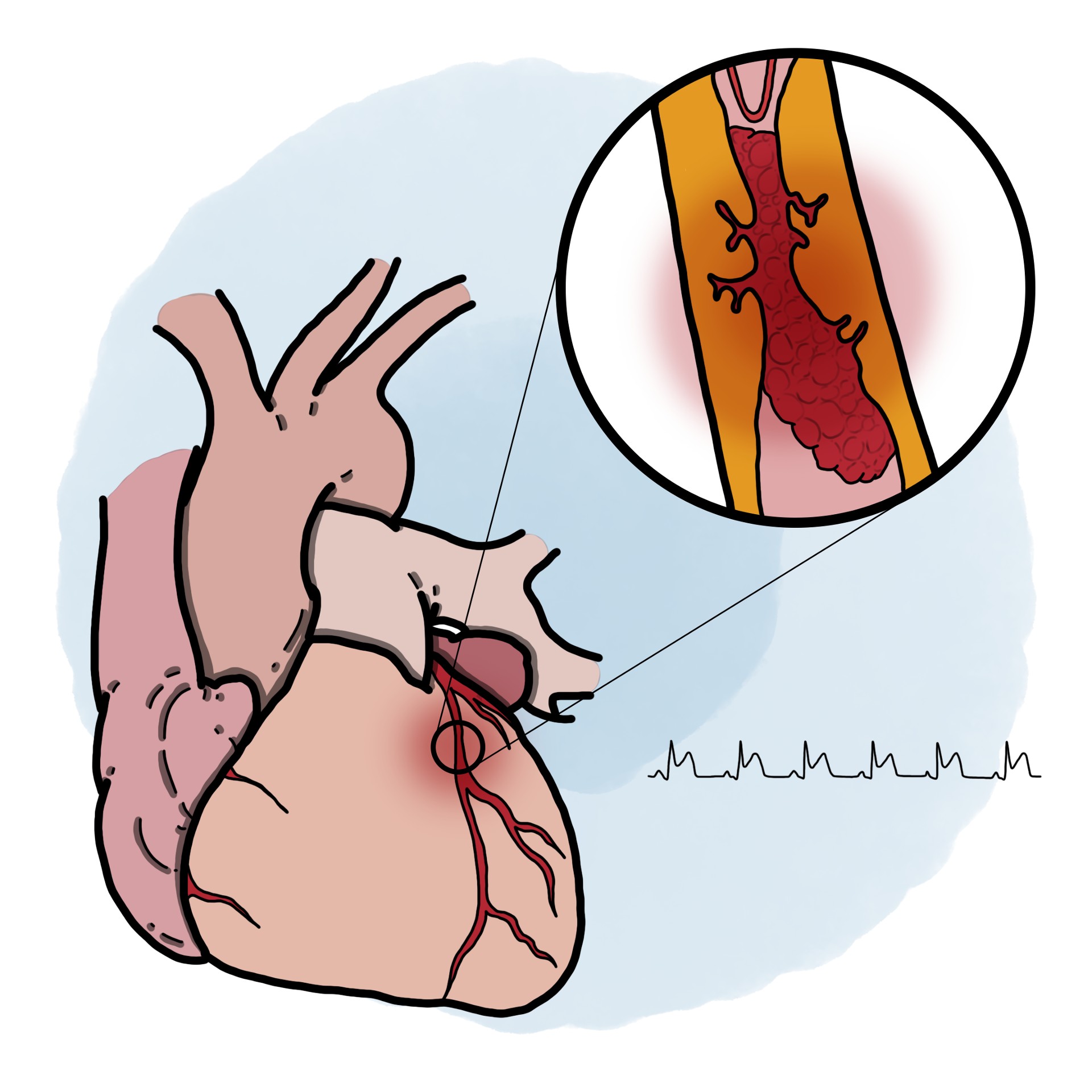 Acute heart attack - Acute coronary syndrome with ST elevation