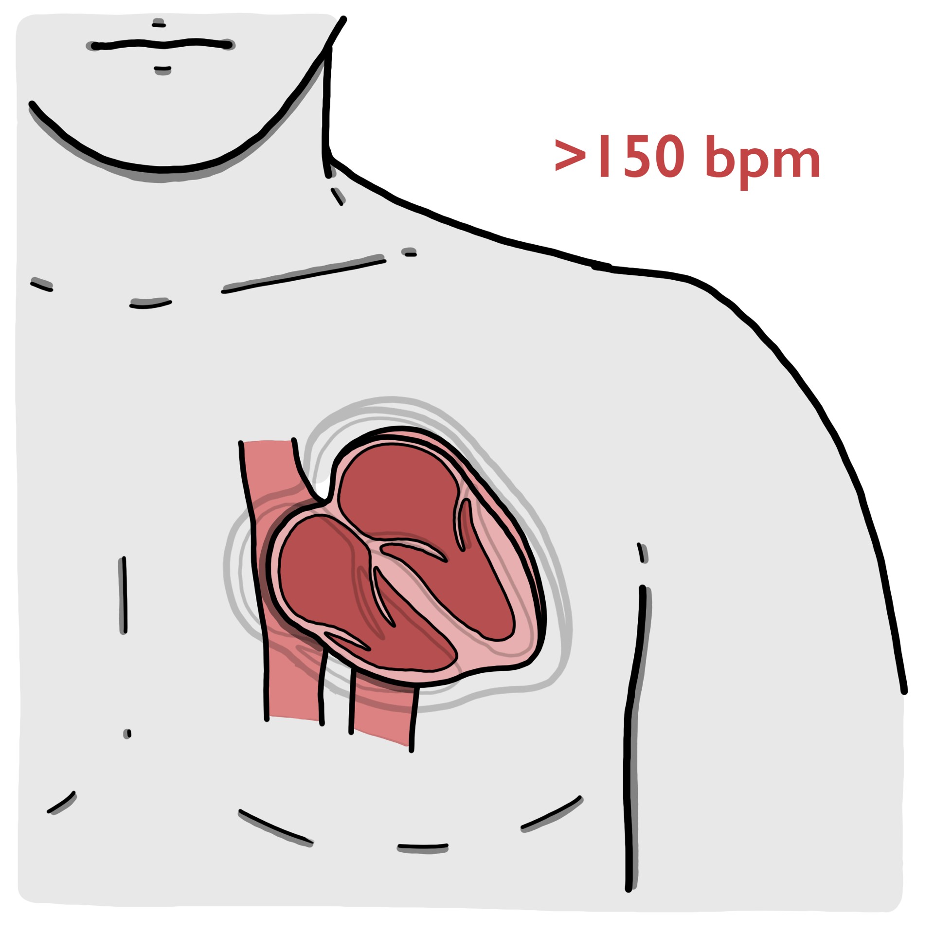 Paroxysmal supraventricular tachycardia