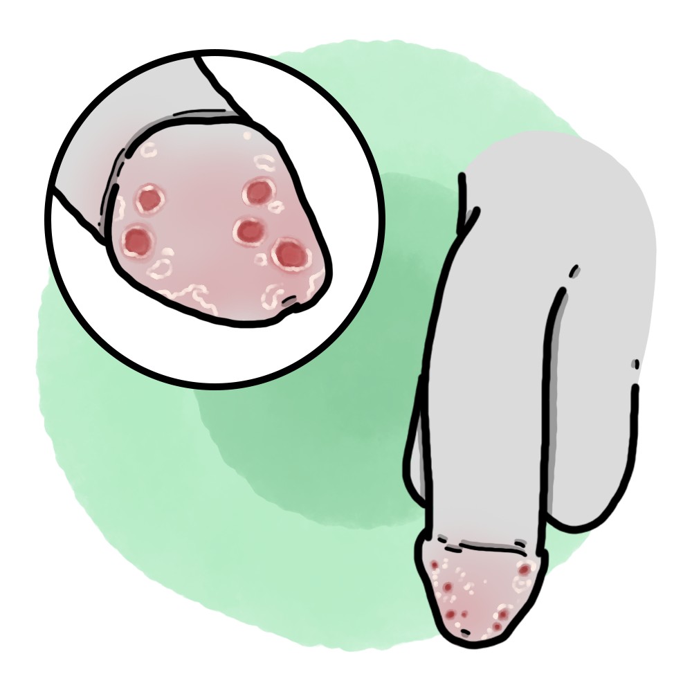 Balanitis (Paediatrics)