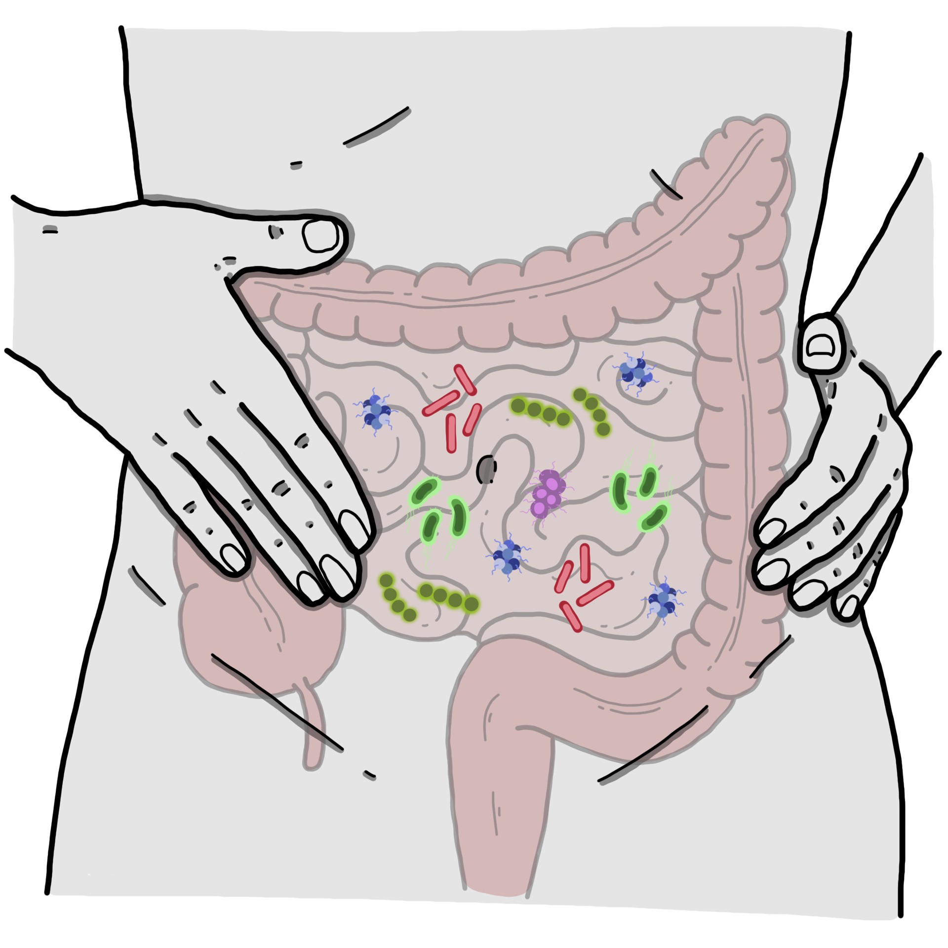 Small intestinal bacterial overgrowth - SIBO
