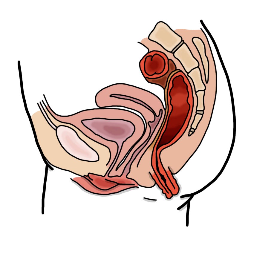 Rectal prolapse
