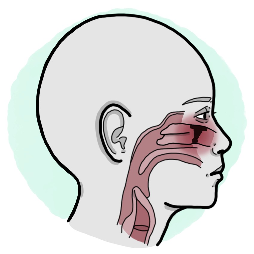 Aspiration of foreign body