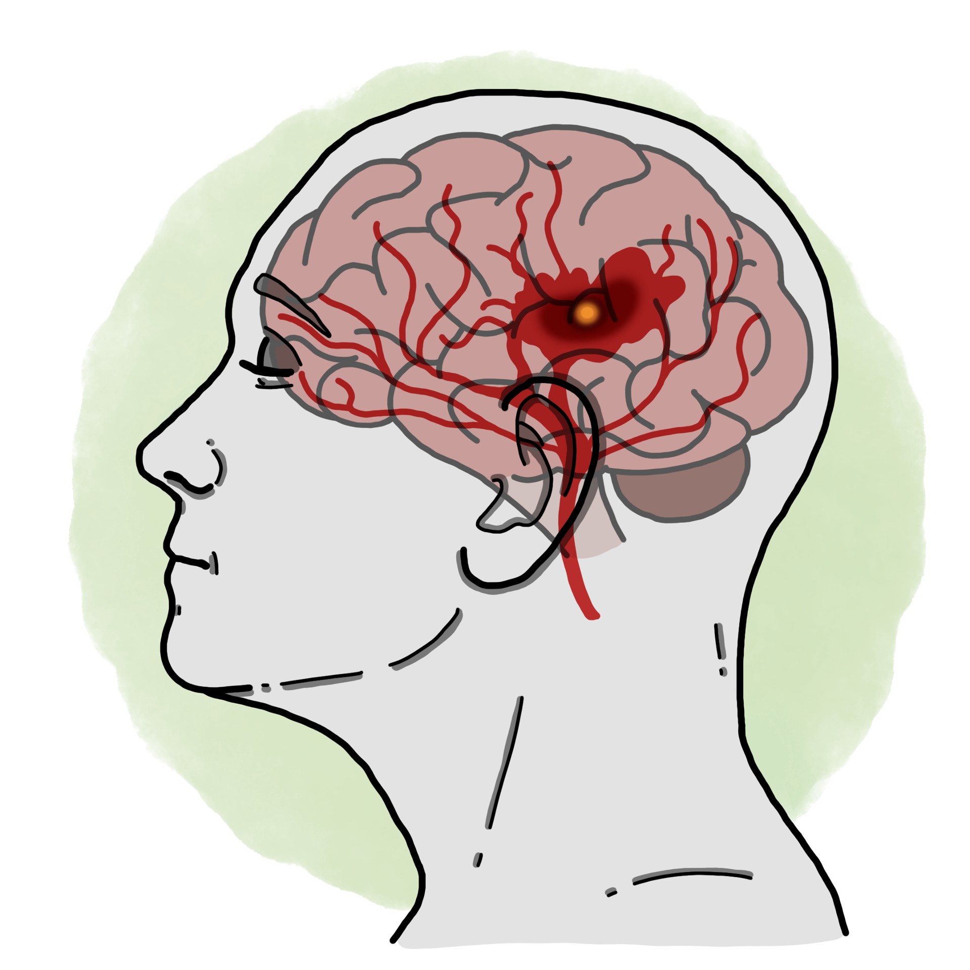 Stroke - Middle cerebral artery