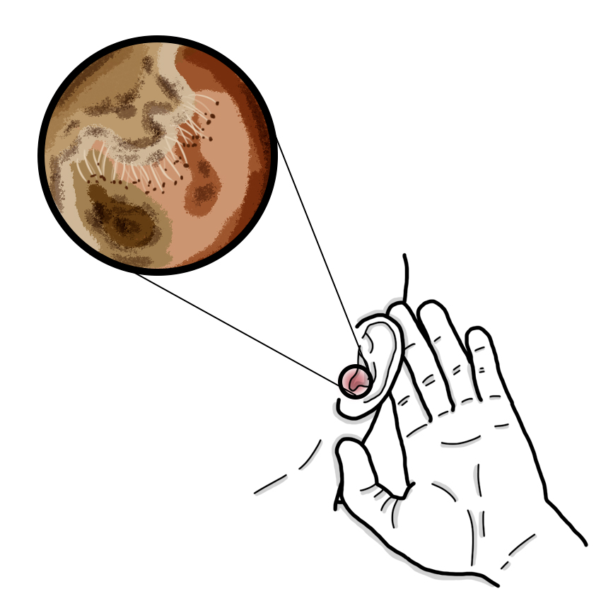 Fungal ear infection - Otomycosis