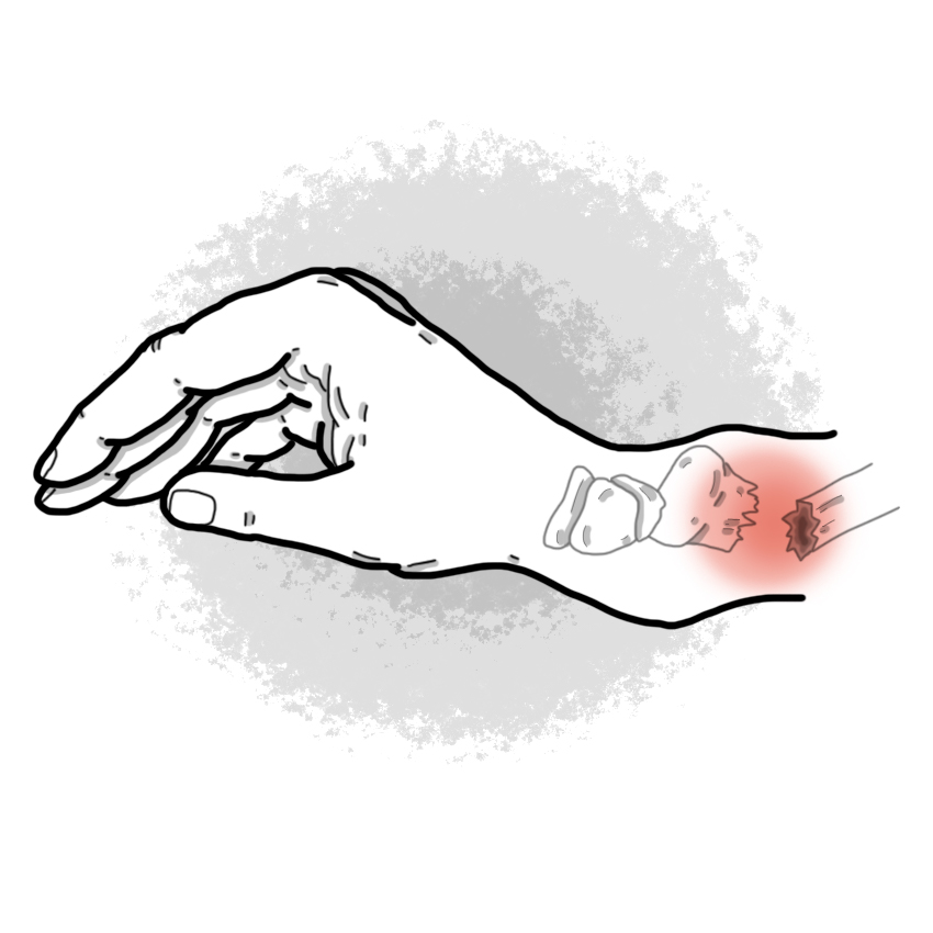 Fracture distale du radius - Fracture de Pouteau-Colles