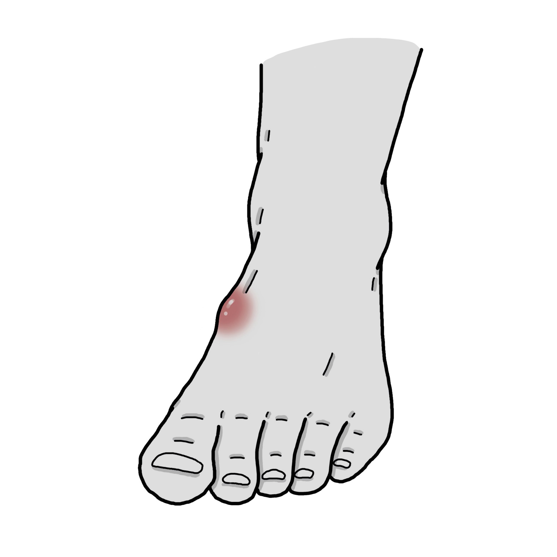 Knoten am Fußrücken