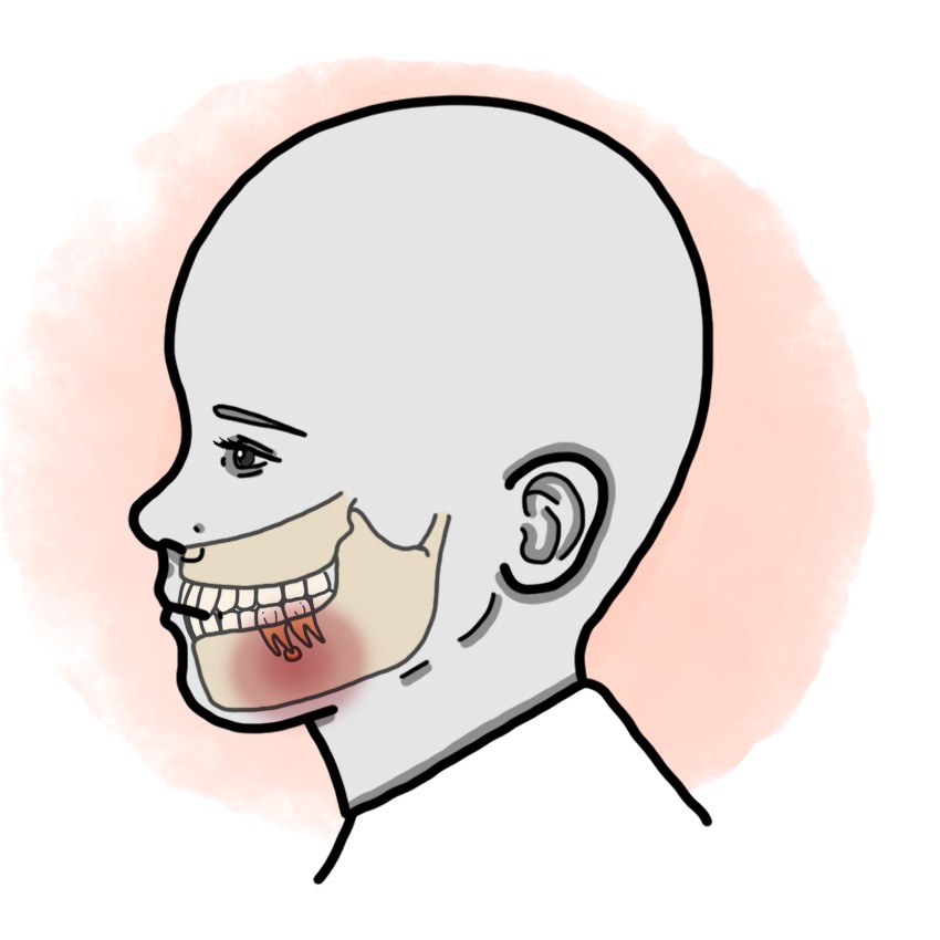 Dental abscess (Paediatrics)