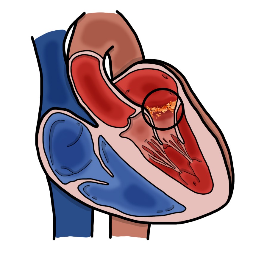 Infective endocarditis (Paediatrics)