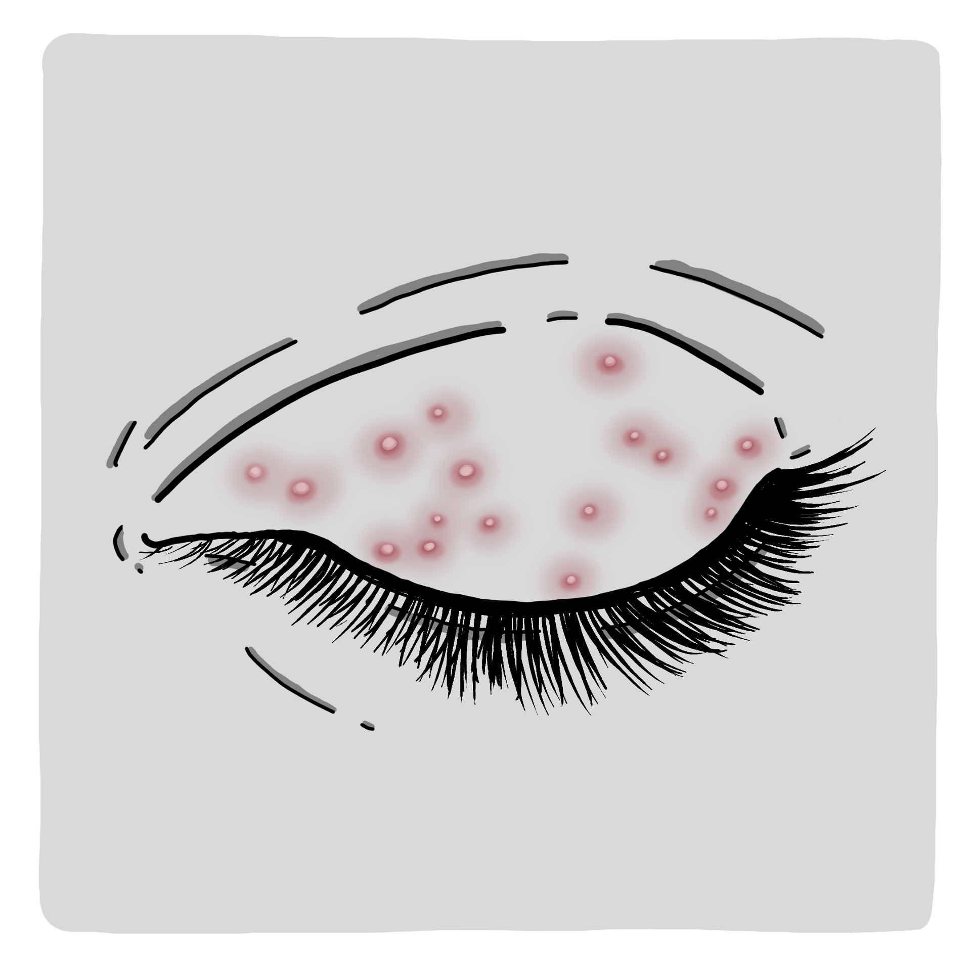 Schmerzhafte Bläschen am Augenlid