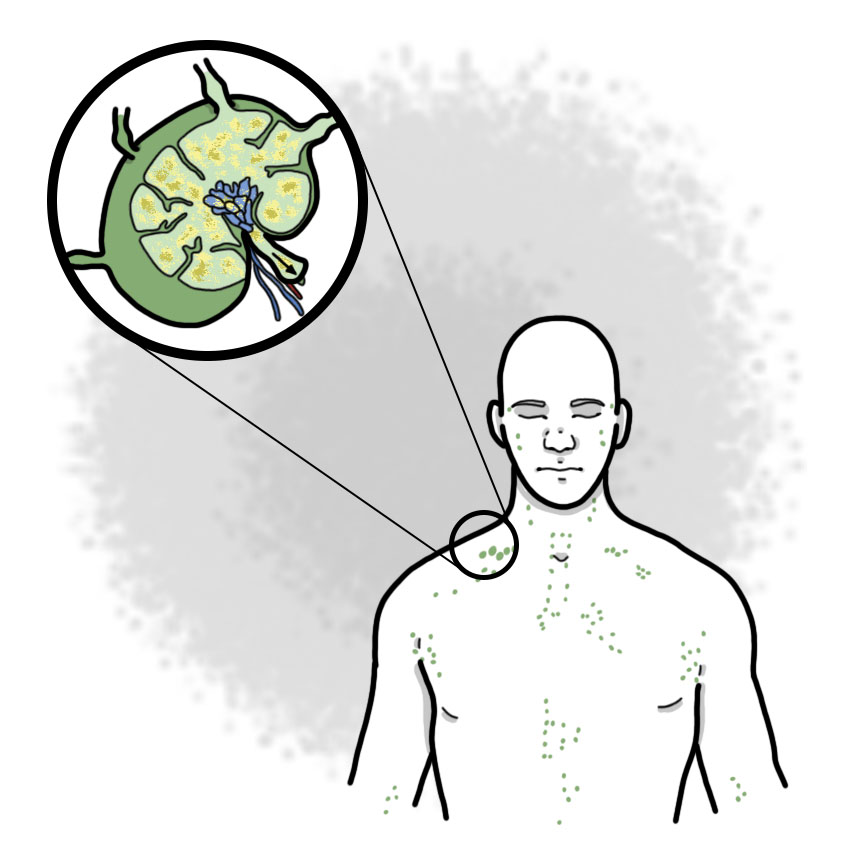 Non-Hodgkin lymphoma