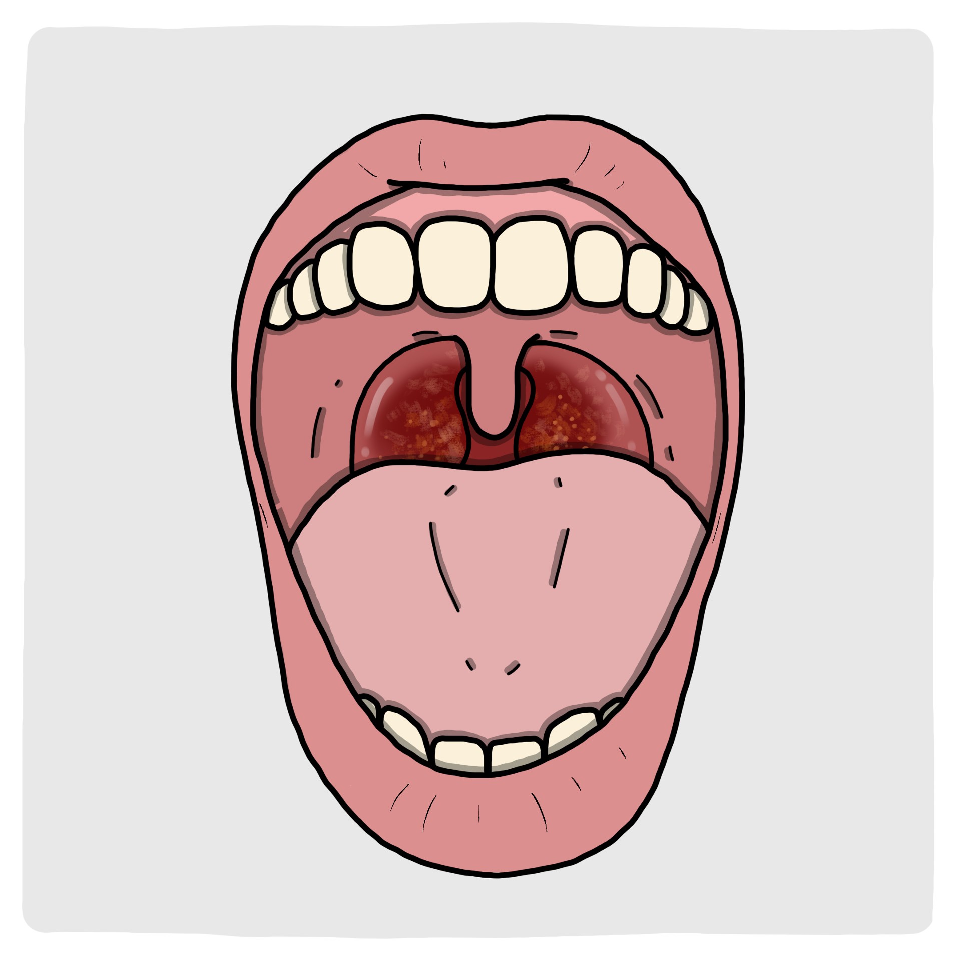 Peritonsillar abscess