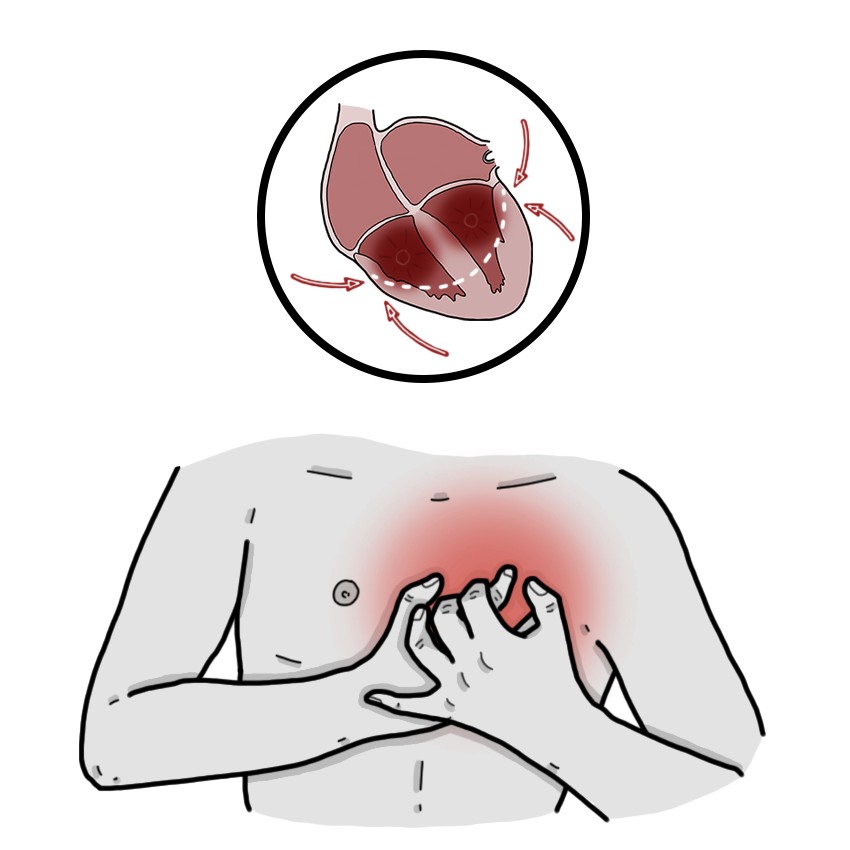 Biventricular heart failure