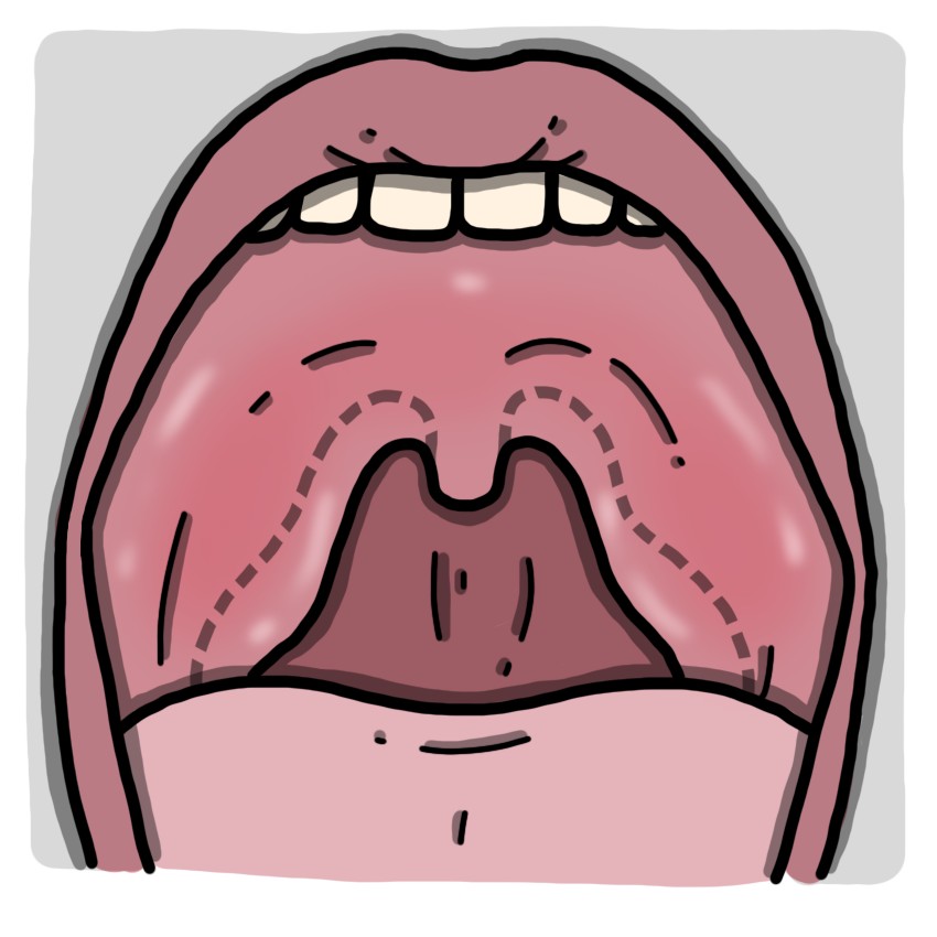 Το εσωτερικό του στόματος είναι οιδημώδες