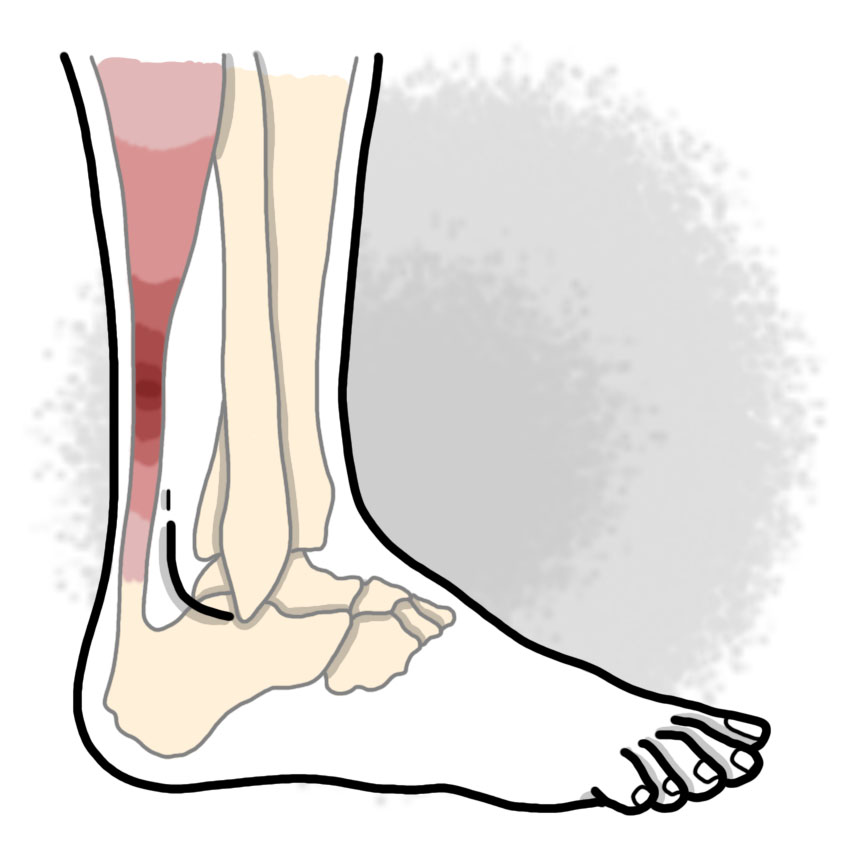 Heel tendinitis