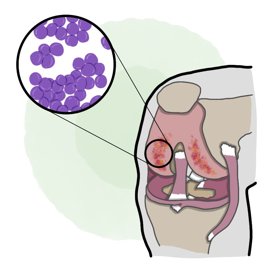 Septic arthritis due to Staphylococcus aureus