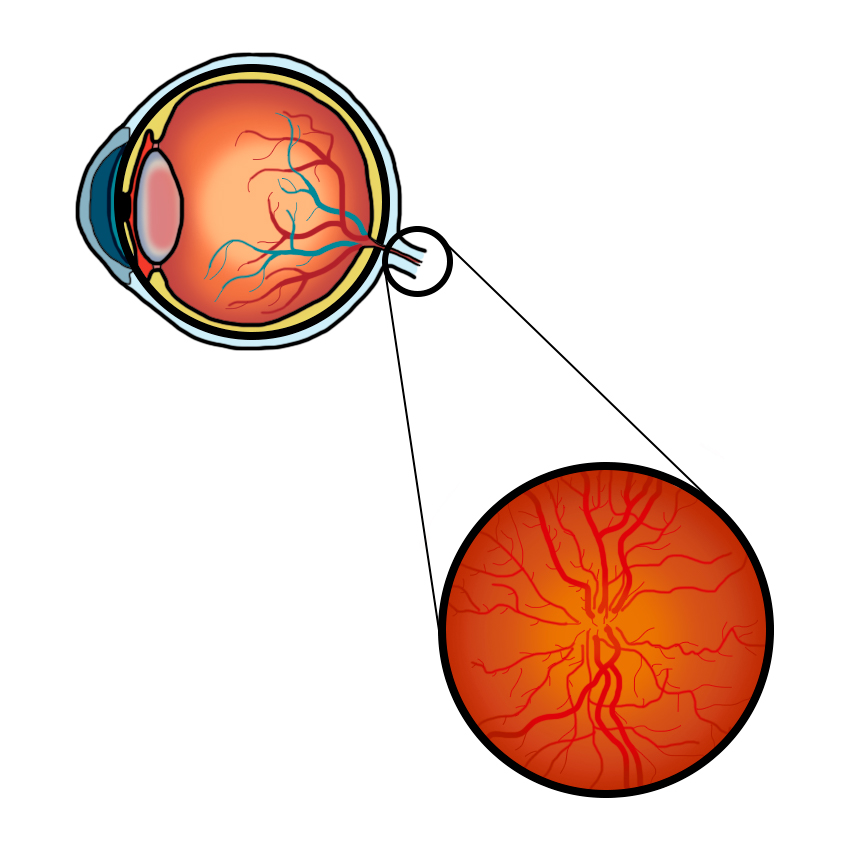 Optic neuropathy