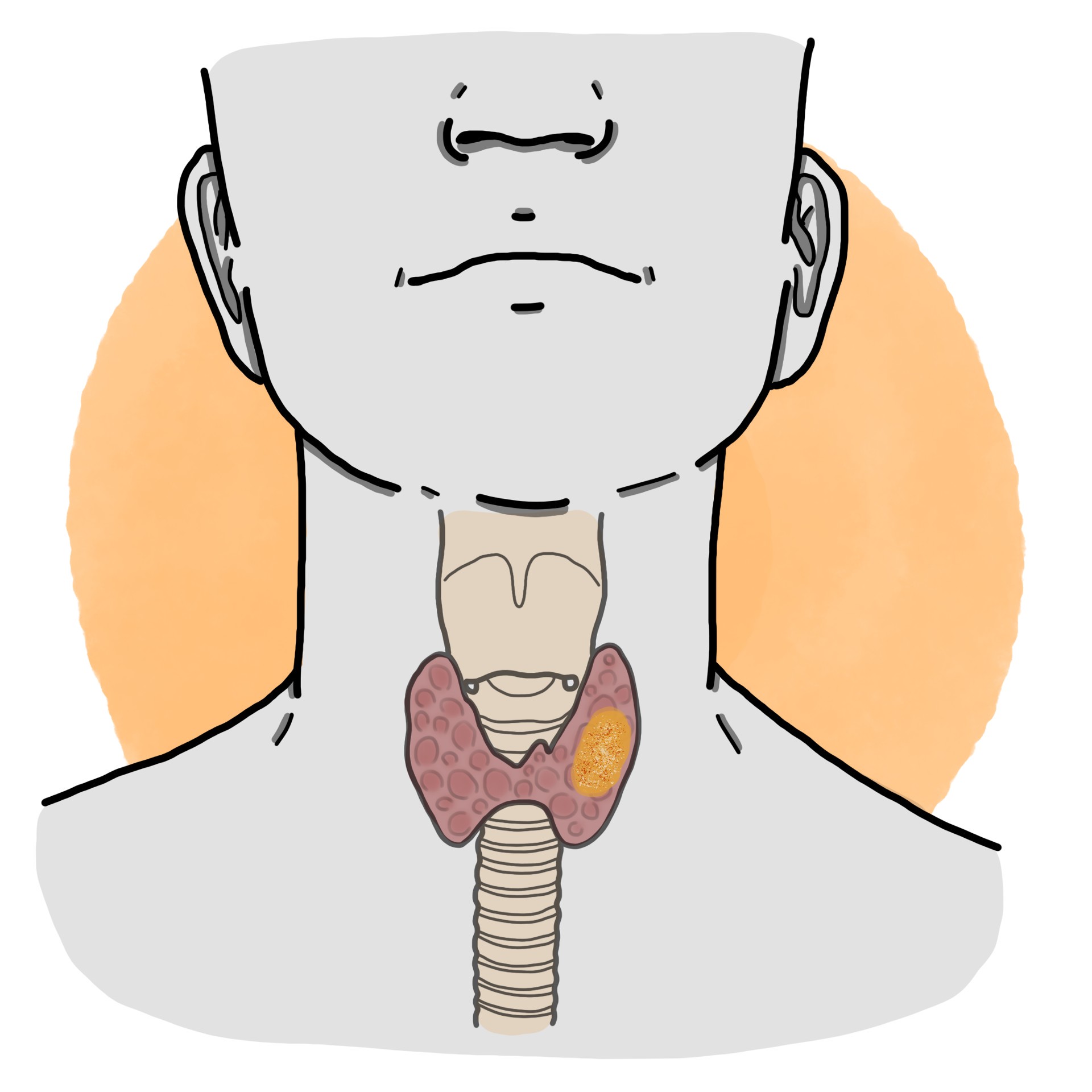 Papillary thyroid carcinoma
