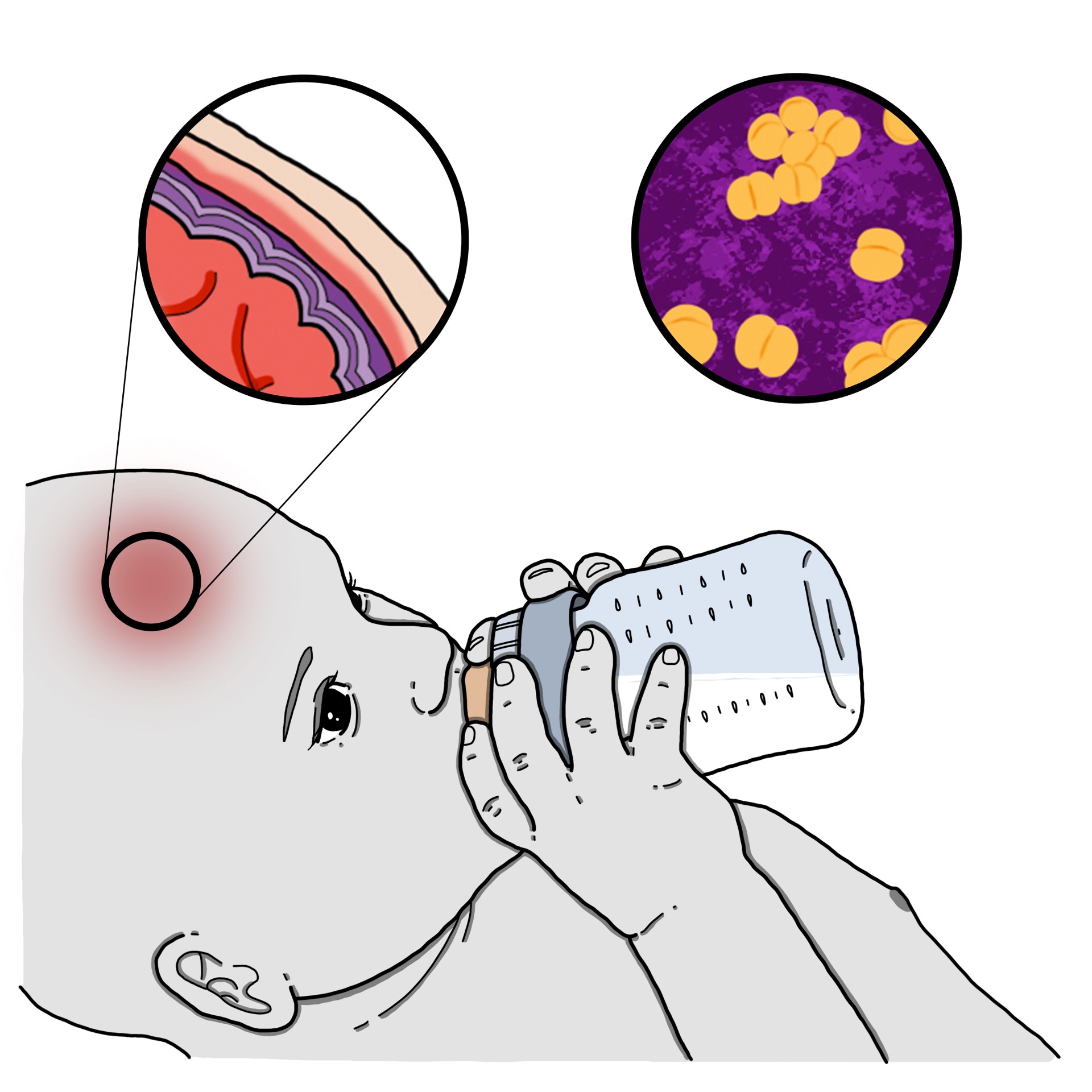 Meningite bacteriana em lactantes (Pediatria)