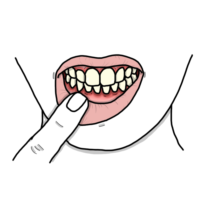 Gingivitis and periodontitis