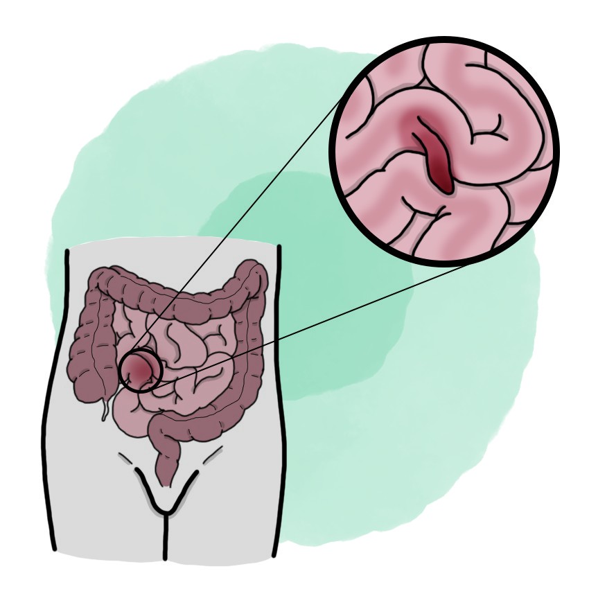 Meckel's diverticulum (Paediatrics)