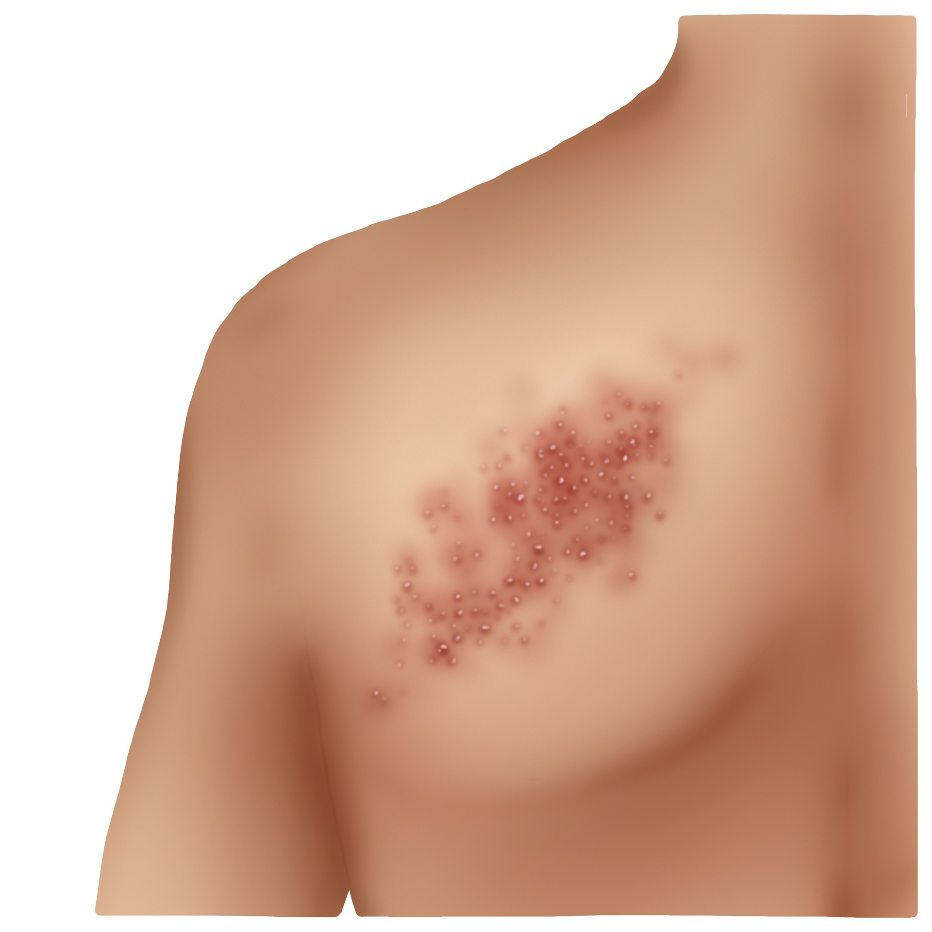 Shingles (Paediatrics)