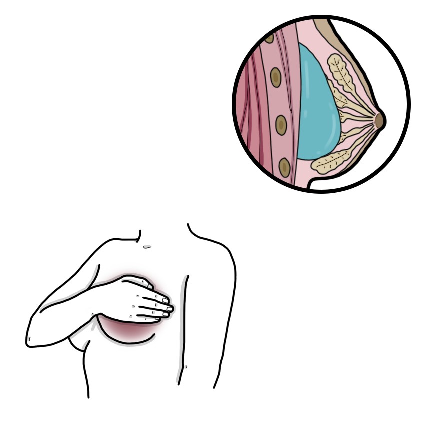 Seroma after breast surgery