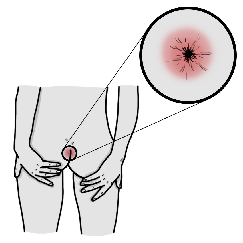 Douleur à l’anus