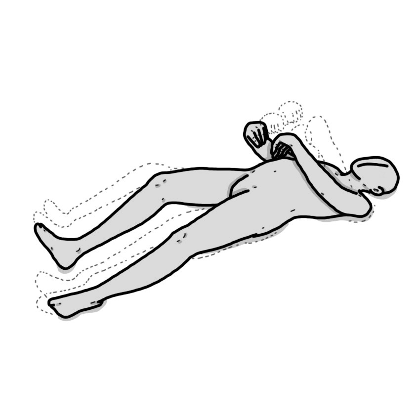 Convulsiones tonicoclónicas