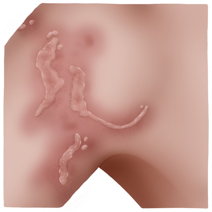 Jellyfish sting injury