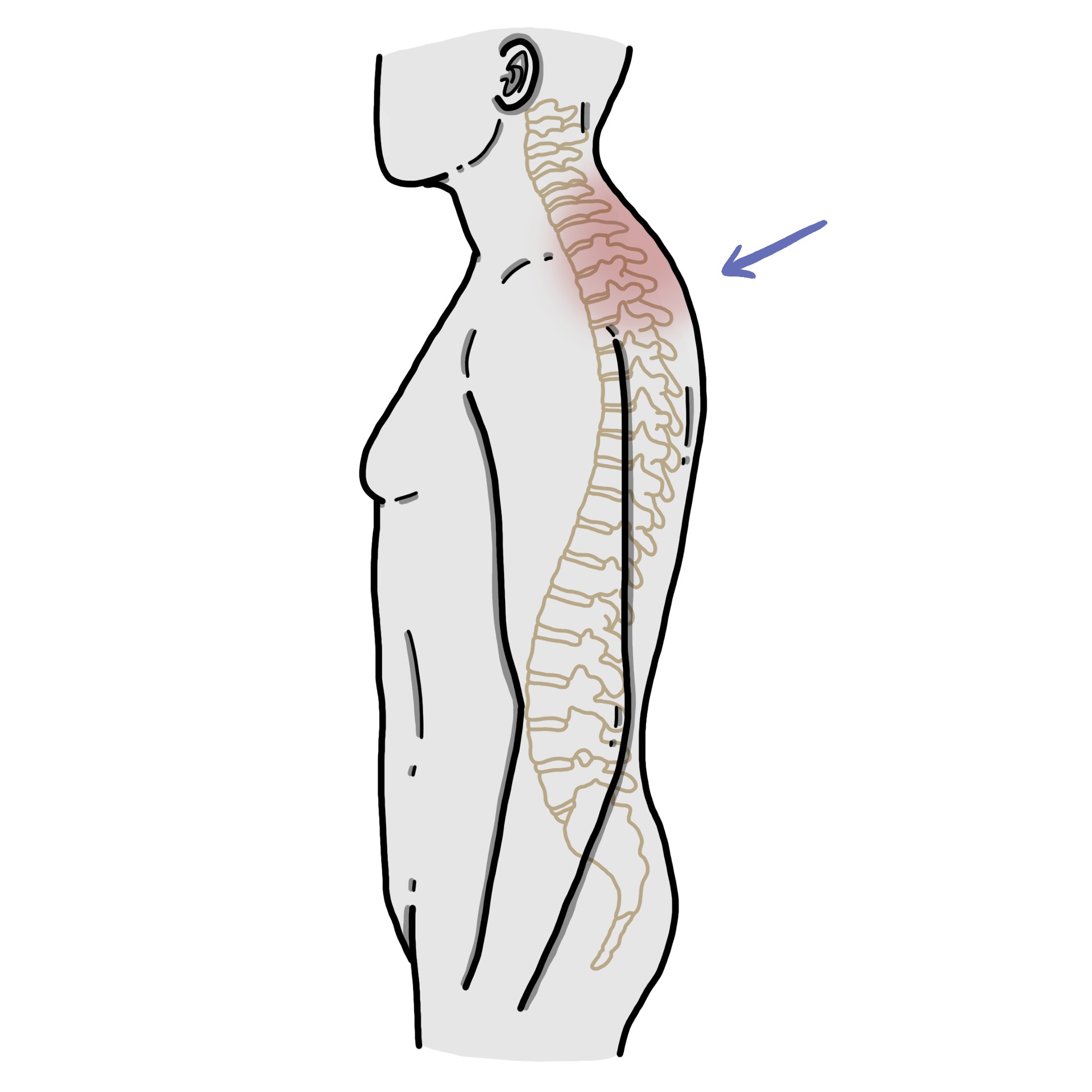 Kyphosis