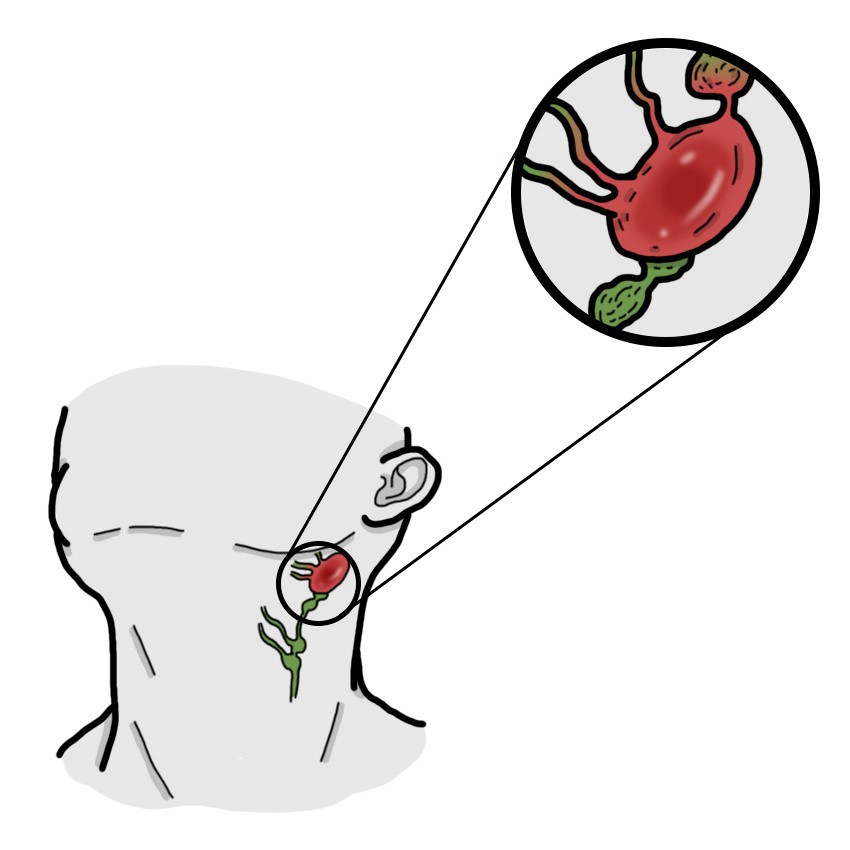 Gezwollen lymfeklier