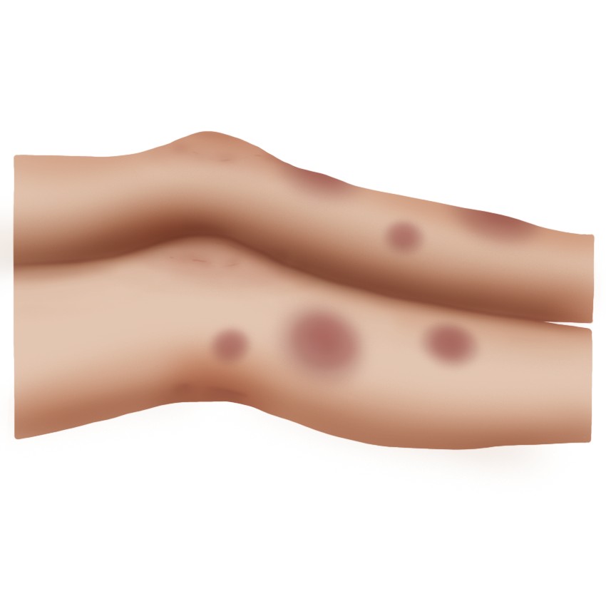Erythema nodosum (Paediatrics)