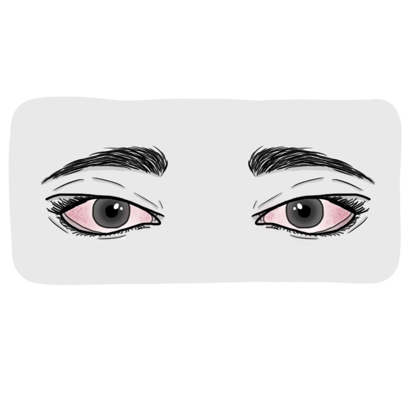 Conjunctival xerosis