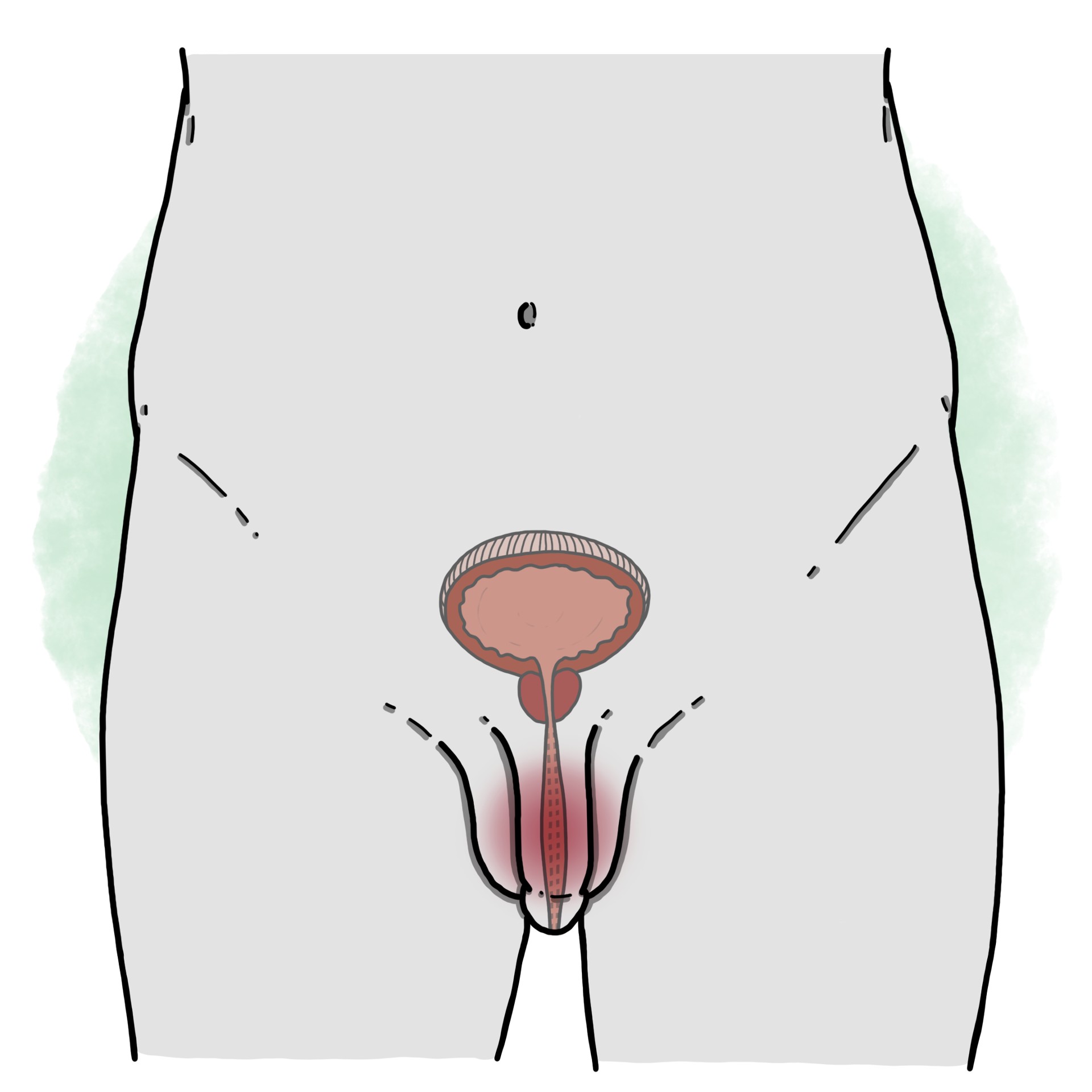 Inflammation of the urethra - Urethritis